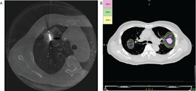 Comparison of clinical outcomes between cone beam CT-guided thermal ablation and helical tomotherapy in pulmonary metastases from hepatocellular carcinoma